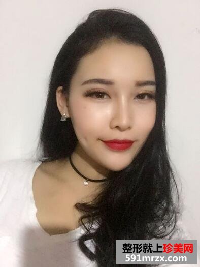 玻尿酸垫下巴，告别小方脸~【诗颜网】