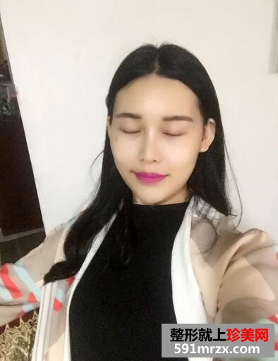 玻尿酸垫下巴，告别小方脸~【诗颜网】