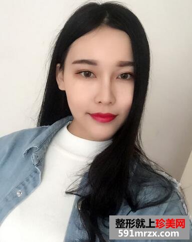 玻尿酸垫下巴，告别小方脸~【诗颜网】