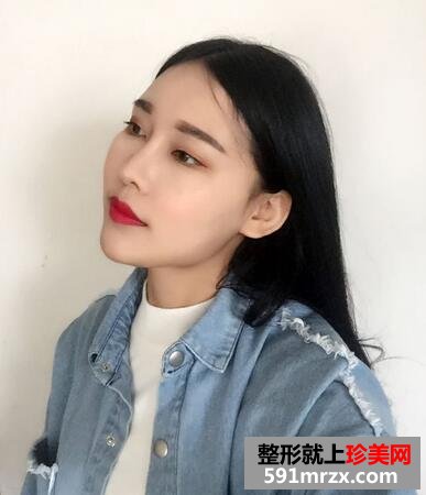 玻尿酸垫下巴，告别小方脸~【诗颜网】