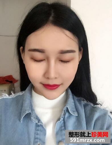 玻尿酸垫下巴，告别小方脸~【诗颜网】