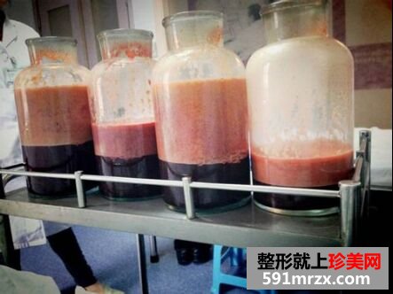 美妞做了大腿吸脂后的恢复图持续更新~
