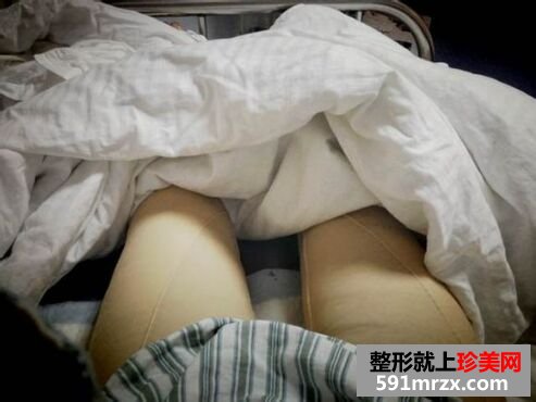 美妞做了大腿吸脂后的恢复图持续更新~