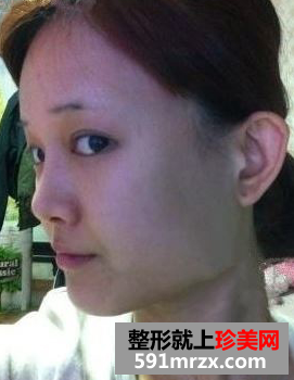 注射胶原蛋白，焕发青春光彩
