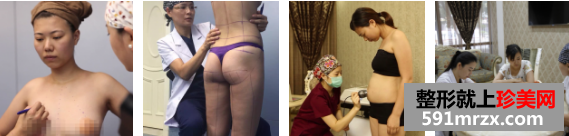 丰胸整形前后对比图，自体脂肪丰胸，吸脂手术