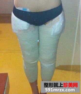 为瘦大腿做了大腿吸脂 特来分享大腿吸脂经历