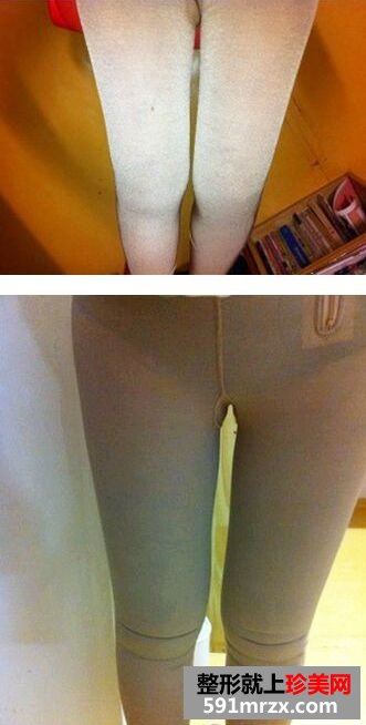 为瘦大腿做了大腿吸脂 特来分享大腿吸脂经历