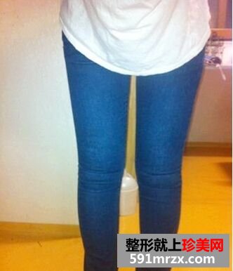 为瘦大腿做了大腿吸脂 特来分享大腿吸脂经历