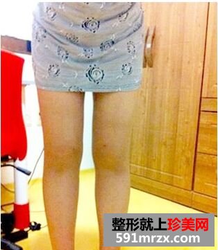 为瘦大腿做了大腿吸脂 特来分享大腿吸脂经历