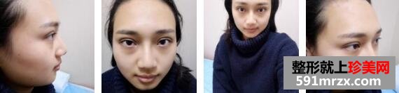 埋线双眼皮前后对比照，隆鼻前后对比照片