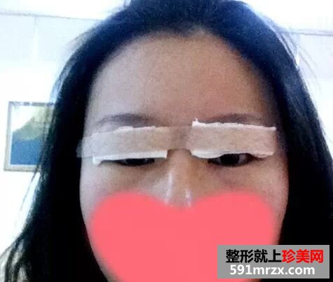 做了全切双眼皮美美哒 分享经验给大家!