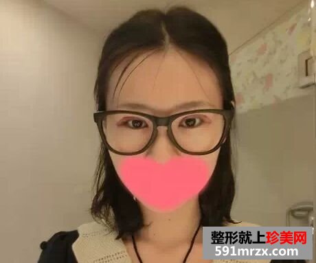 做了全切双眼皮美美哒 分享经验给大家!