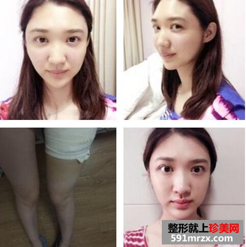 武汉伊美馨陈远海自体脂肪填充95天恢复案例图