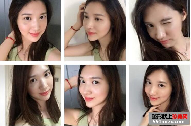 武汉伊美馨陈远海自体脂肪填充95天恢复案例图