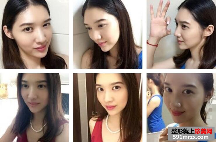 武汉伊美馨陈远海自体脂肪填充95天恢复案例图