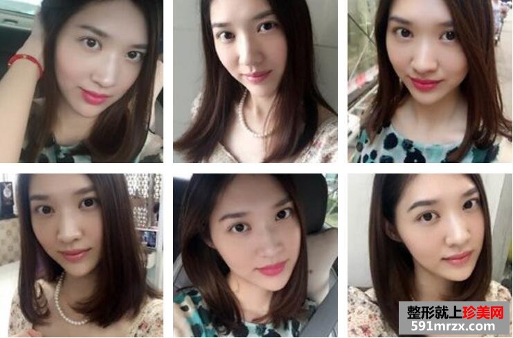 武汉伊美馨陈远海自体脂肪填充95天恢复案例图