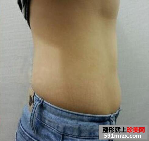 减肥方法，吸脂减肥图片