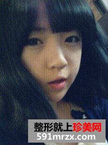双眼皮开眼角+假体隆鼻 整个人气质提升不少
