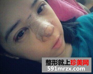 双眼皮开眼角+假体隆鼻 整个人气质提升不少