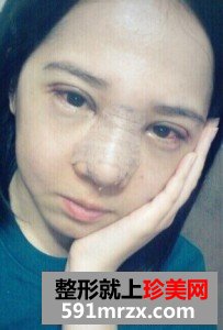 双眼皮开眼角+假体隆鼻 整个人气质提升不少