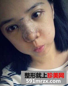 双眼皮开眼角+假体隆鼻 整个人气质提升不少