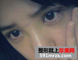 双眼皮开眼角+假体隆鼻 整个人气质提升不少