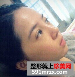 双眼皮开眼角+假体隆鼻 整个人气质提升不少
