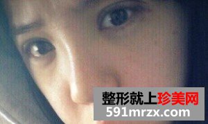 双眼皮开眼角+假体隆鼻 整个人气质提升不少