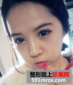 双眼皮开眼角+假体隆鼻 整个人气质提升不少