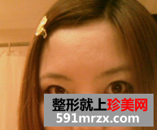 去眼袋术后恢复日记