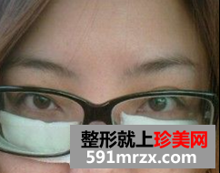 去眼袋术后恢复日记