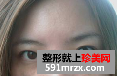 去眼袋术后恢复日记