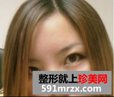 去眼袋术后恢复日记