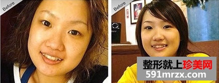打瘦脸针和隆鼻前后对比图