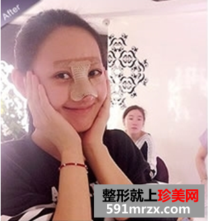 打瘦脸针和隆鼻前后对比图