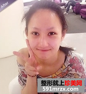 打瘦脸针和隆鼻前后对比图