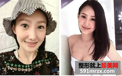 打瘦脸针和隆鼻前后对比图