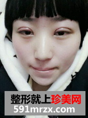 北京医院赵红艺做双眼皮怎么样？赵红艺双眼皮案例