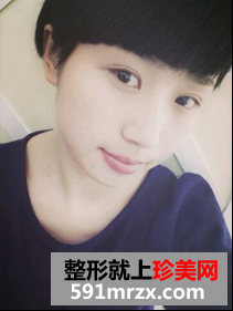 北京医院赵红艺做双眼皮怎么样？赵红艺双眼皮案例
