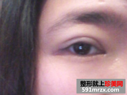 埋线双眼皮前后效果对比图和恢复过程
