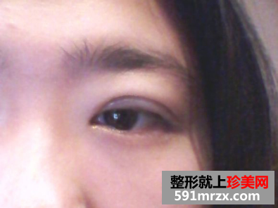 埋线双眼皮前后效果对比图和恢复过程