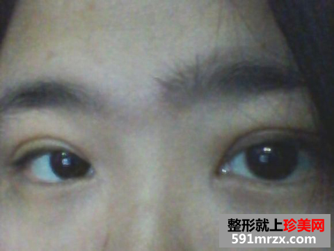 埋线双眼皮前后效果对比图和恢复过程