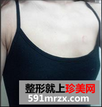 北京八大处李发成自体脂肪丰胸怎么样？李发成丰胸案例