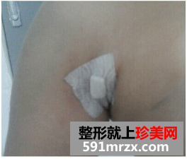 北京八大处李发成自体脂肪丰胸怎么样？李发成丰胸案例