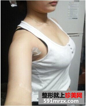 北京八大处李发成自体脂肪丰胸怎么样？李发成丰胸案例