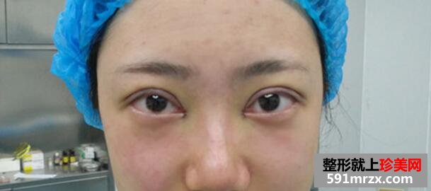 5980元割双眼皮+开眼角整形前后对比图