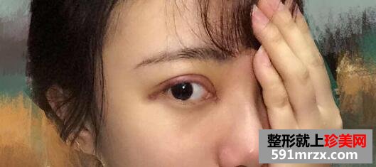 开双眼皮和开眼角价格，整形图片