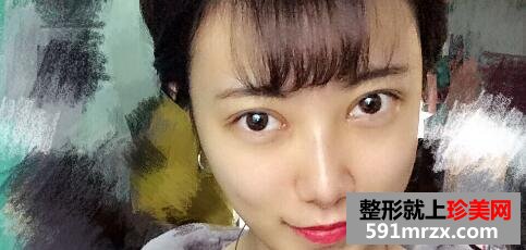 割双眼皮+开眼角拆线后图片