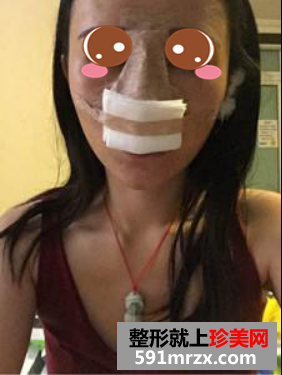 膨体隆鼻真人案例对比图