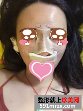 膨体隆鼻真人案例对比图